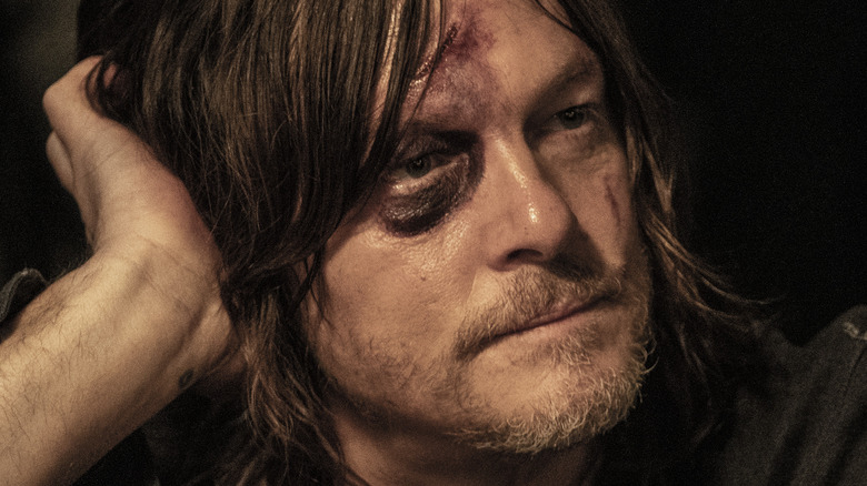 Daryl with black eye